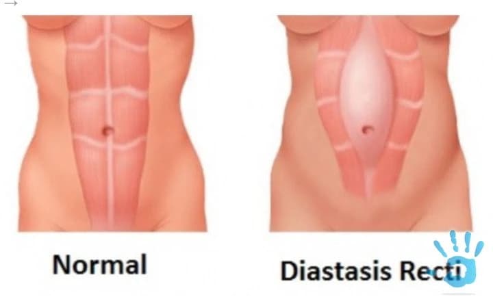 terapia-diastazy-brusnych-svalov-po-porode