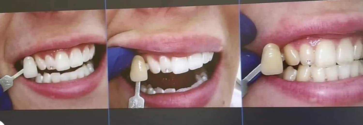 dentalna-hygiena-bielenie-lepenie-sperku-na-zub-zdravie-aj-krasa
